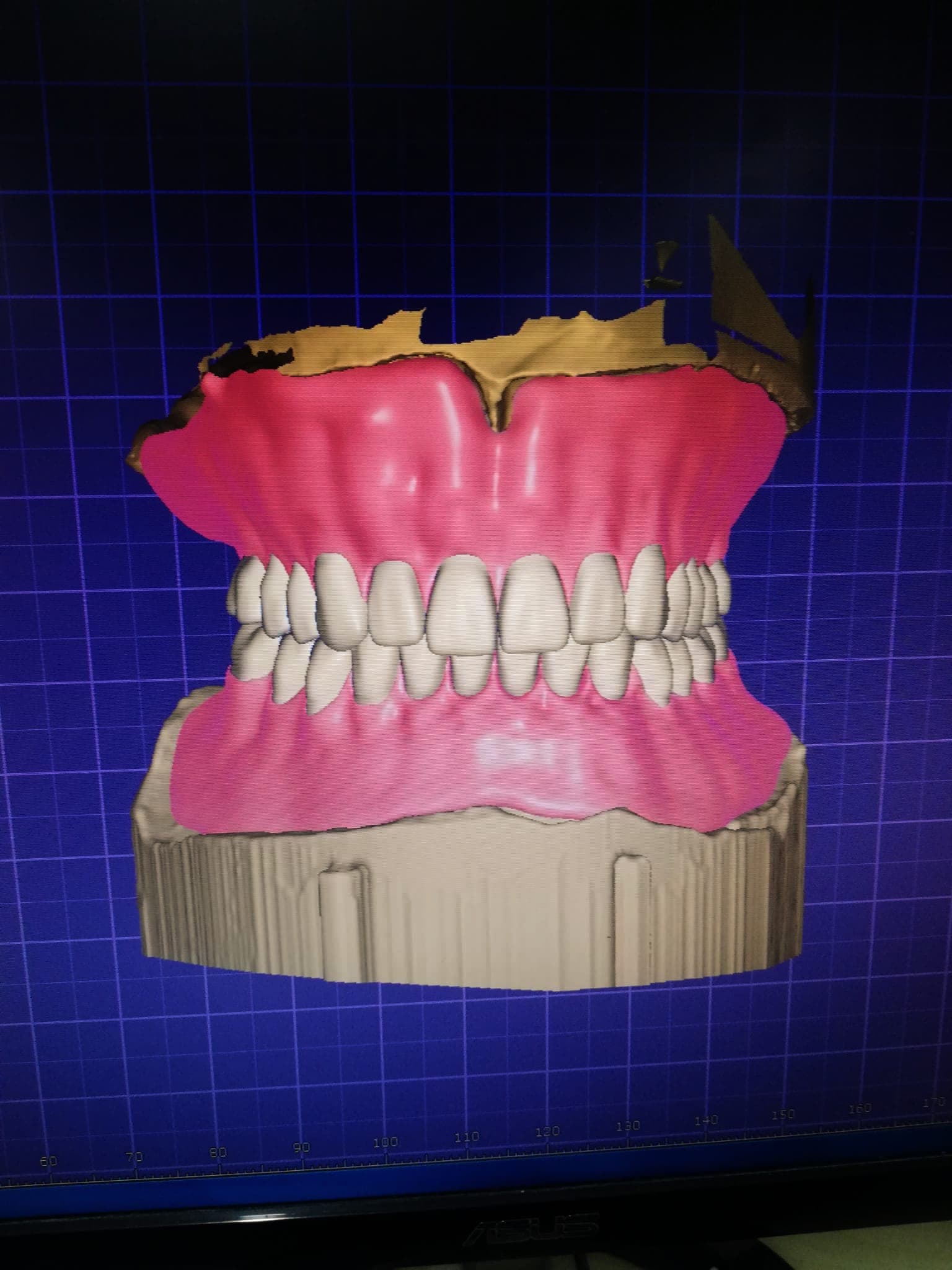 FUL DENTURE DESΔ°NG