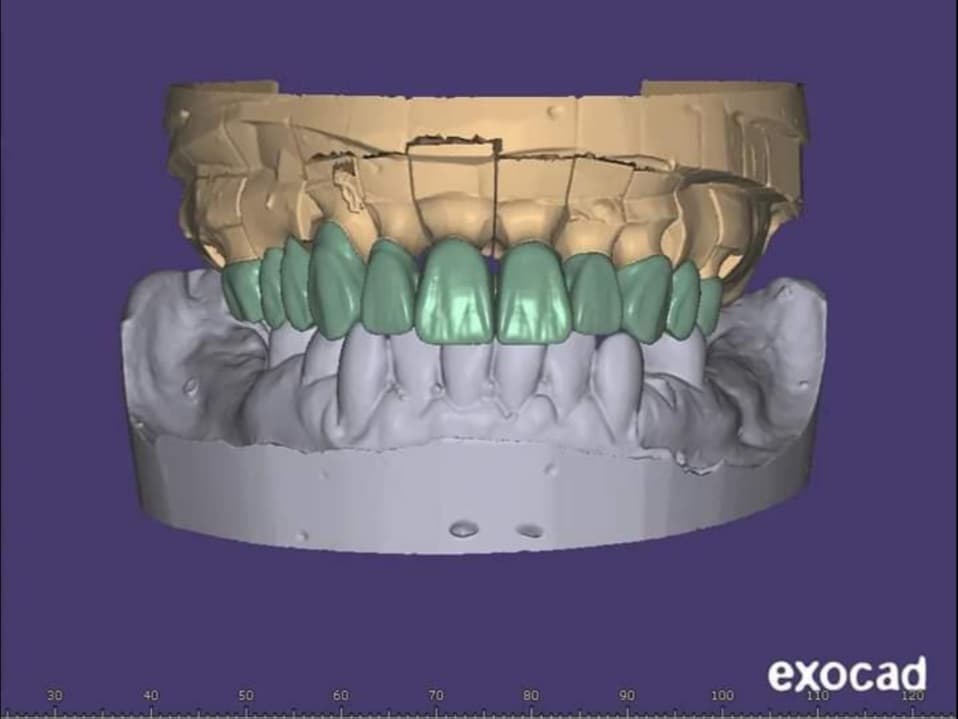 Bridge of 11 anatomic crowns