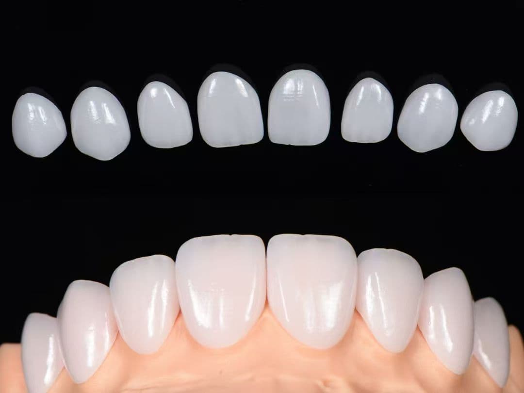 Porcelain veneer aesthetic restoration