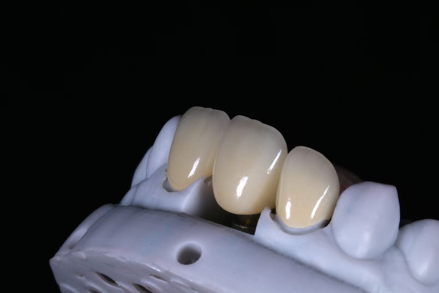 porcelain fused to zirconia