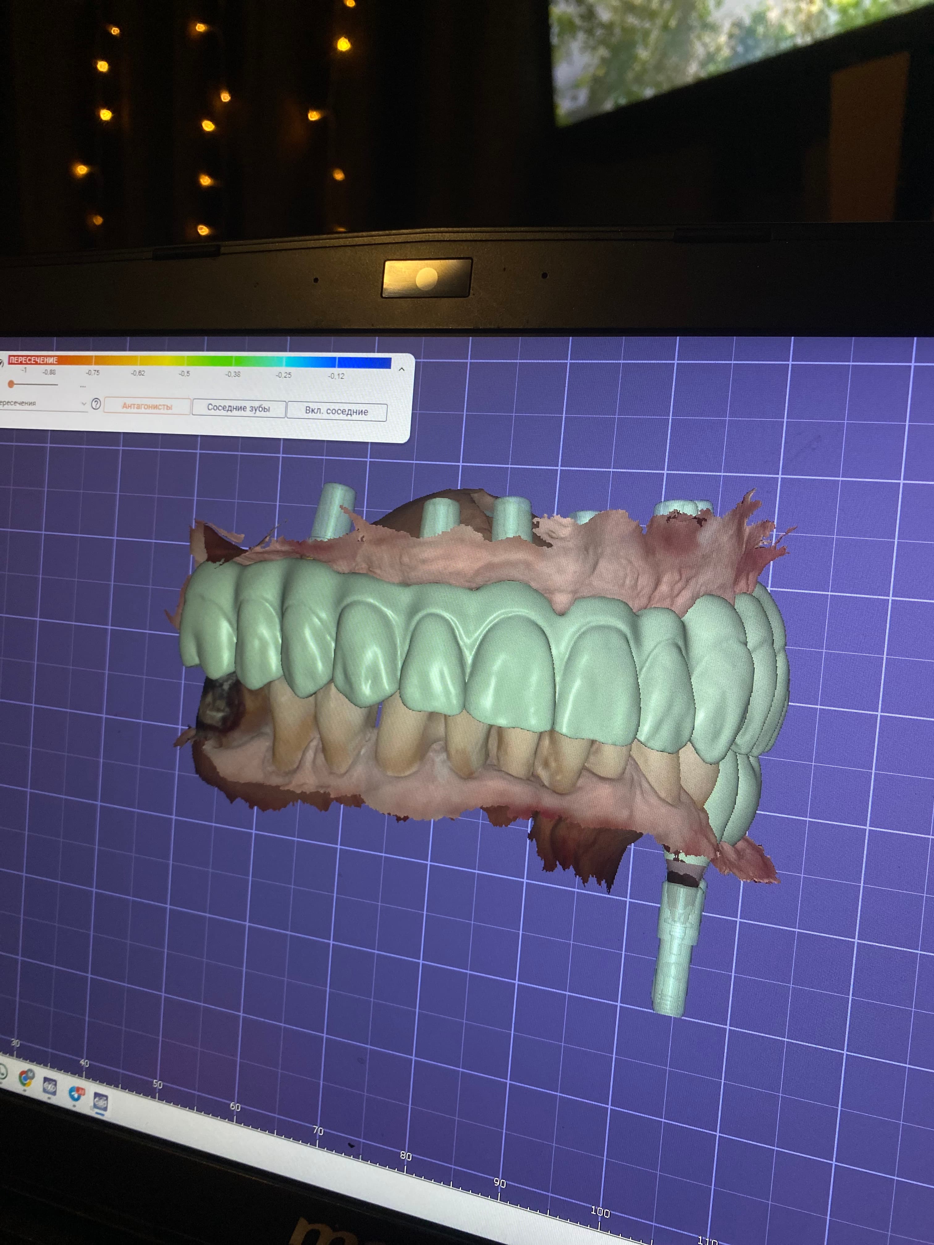 Dental CAD Design β Crowns, Bridges & Implant Cases (exocad)