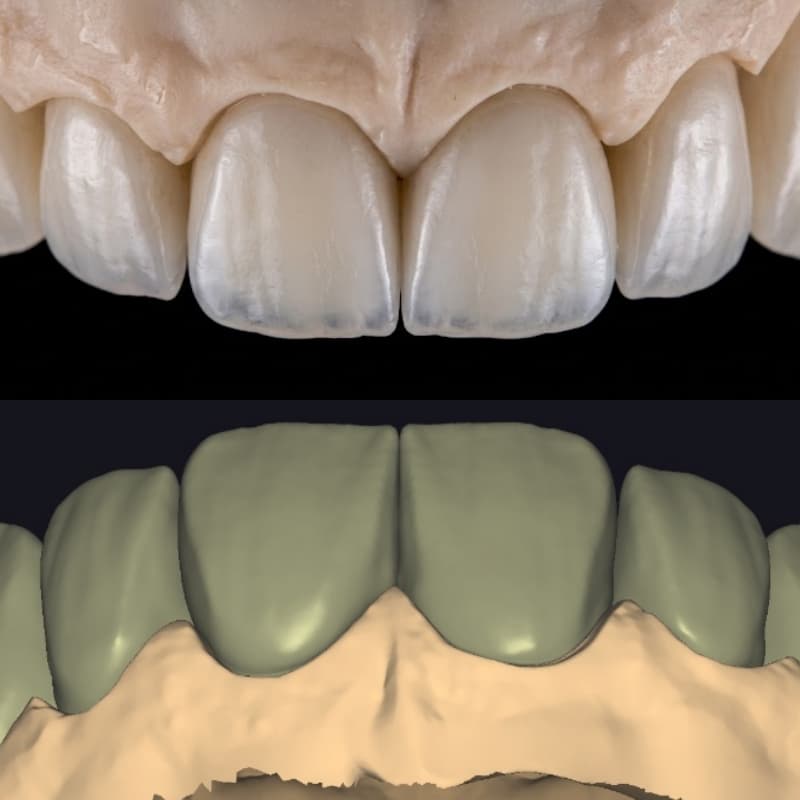High-End Aesthetic Veneer Design | Digital Smile Design (DSD)