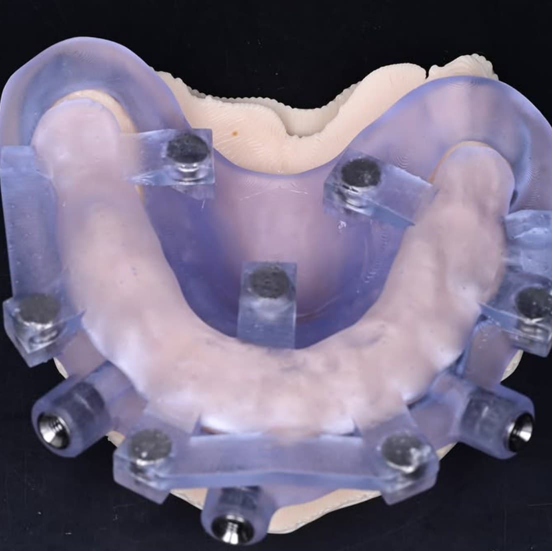 Stackable Surgical Guide Set for Full-Arch Immediate Load (Bone Reduction + Pilot + Final)