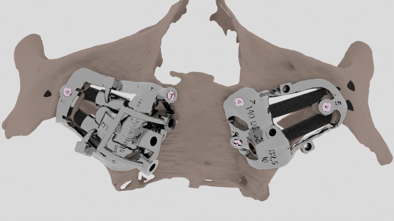 Zigoma Guide: Patented Stackable Surgical Guide for Zygomatic Implants