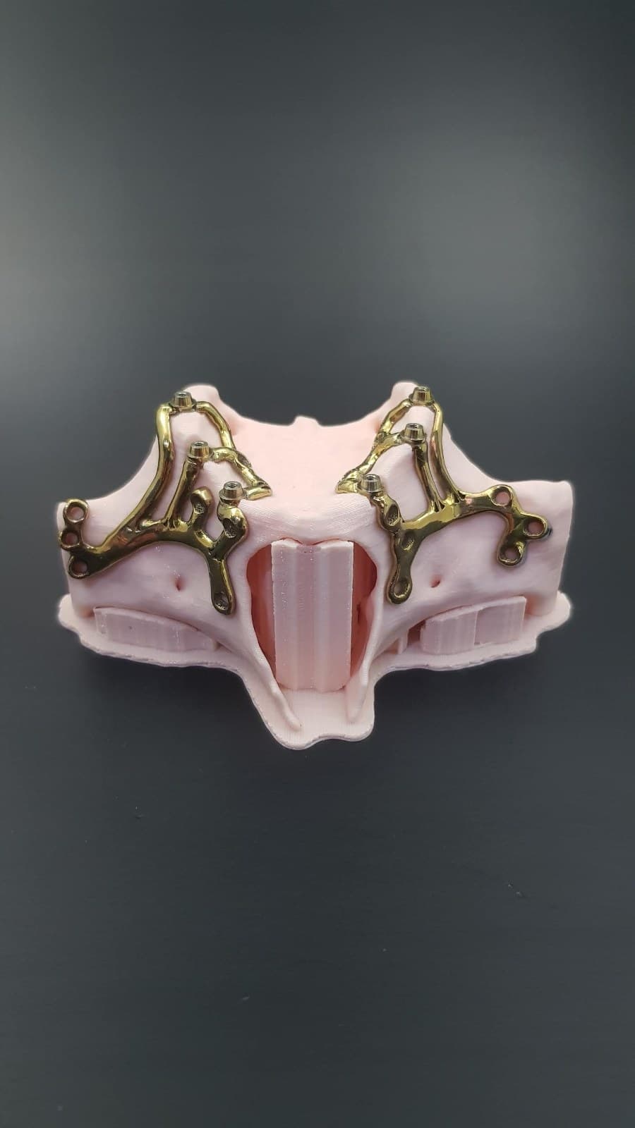 Custom Subperiosteal Implant (SPI): Patient-Specific Design + Ti6Al4V Production