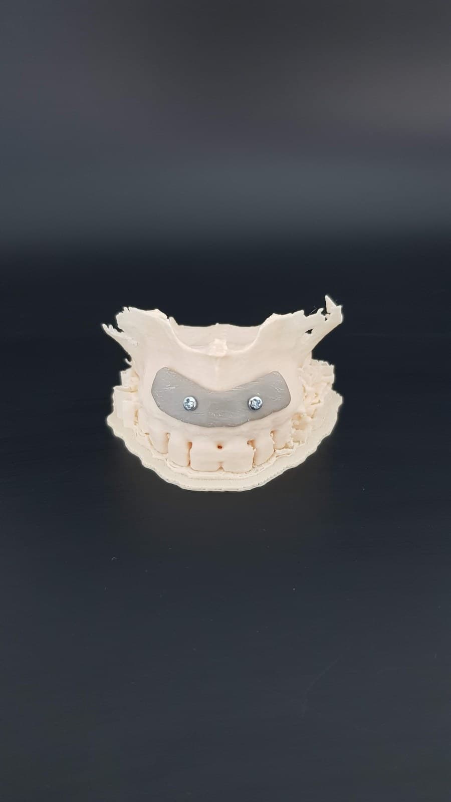 Patient-Specific 3D Printed Implants (Ti6Al4V / PEEK / PEKK) for Maxillofacial & Reconstructive Surgery