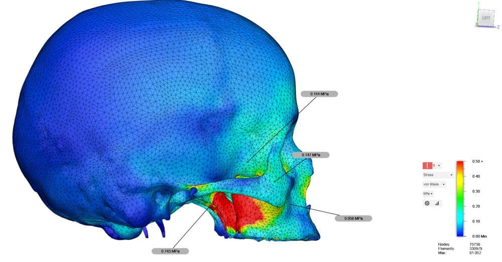 Finite Element Analysis (FEA) & Research Support for Dental Implant and Prosthetic Studies