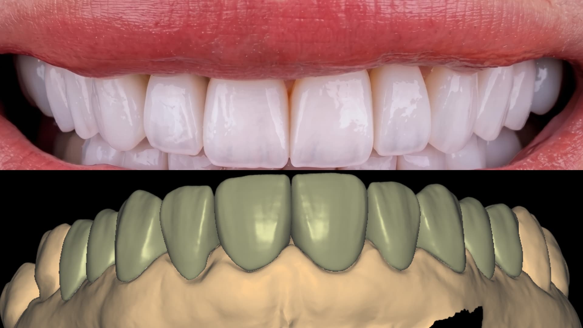 Veneer Design - Digital Smile Design (DSD)