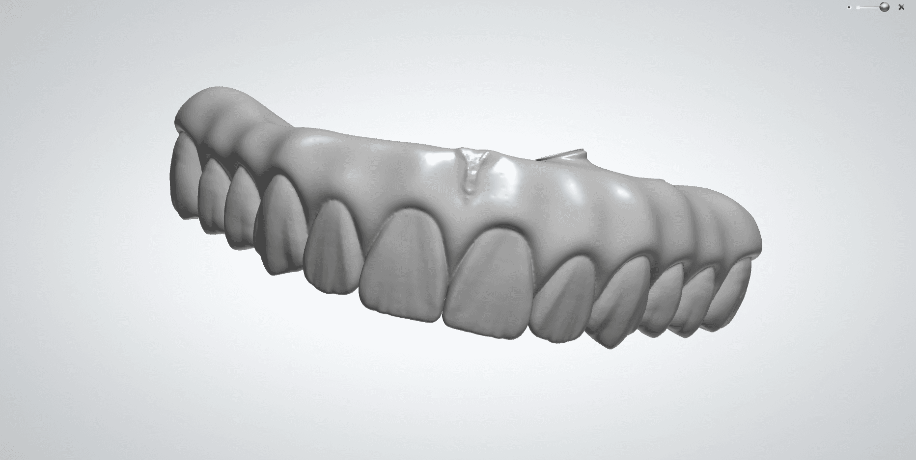 Full Arch Implant-Supported Prosthesis β 12-Hour Turnaround