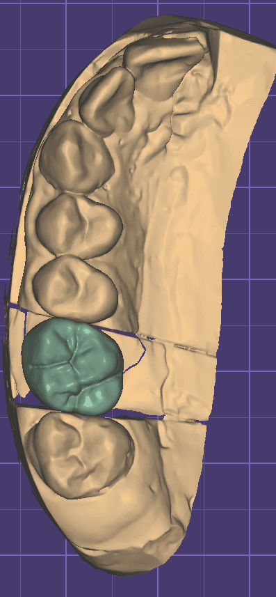 Exocad Single Crown Design