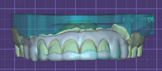 Gingivectomy surgical guide