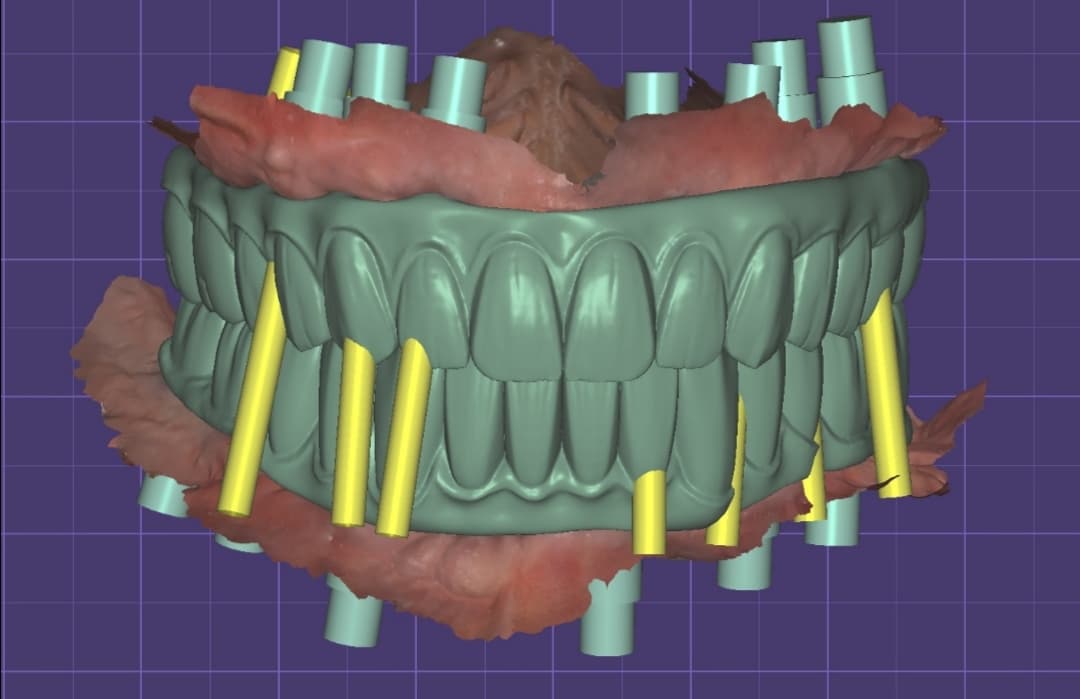 βProfessional Dental CAD Design | Crowns, Bridges & Full-Arch Implants (per unit)