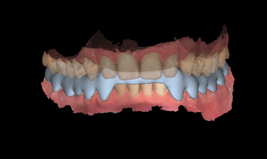 I will create a precise bite splint design using Exocad