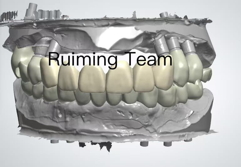 Custom Implant Abutment CAD Design | 3Shape