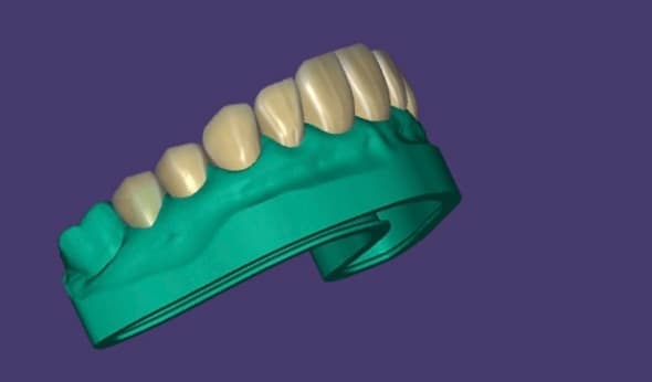 Full-Arch Zirconia Design