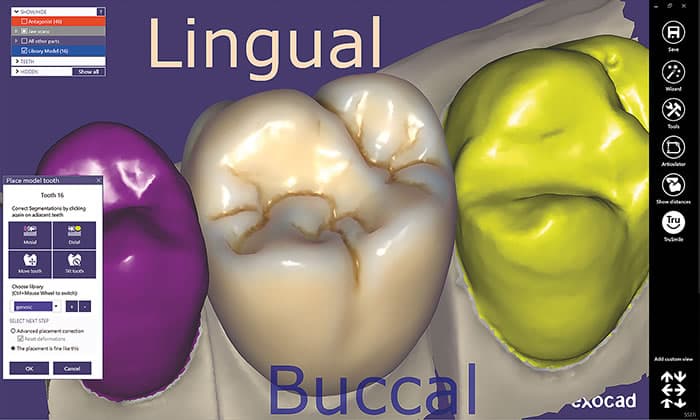 Single Crown Dental CAD Design – Exocad