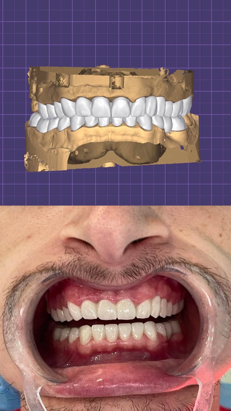 Full Arch Zirconia