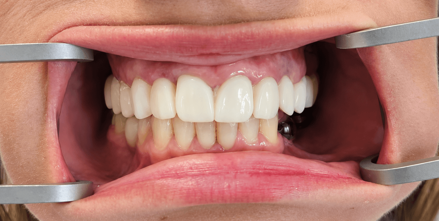 Implant Planning Tooth Setup – Surgical Reference