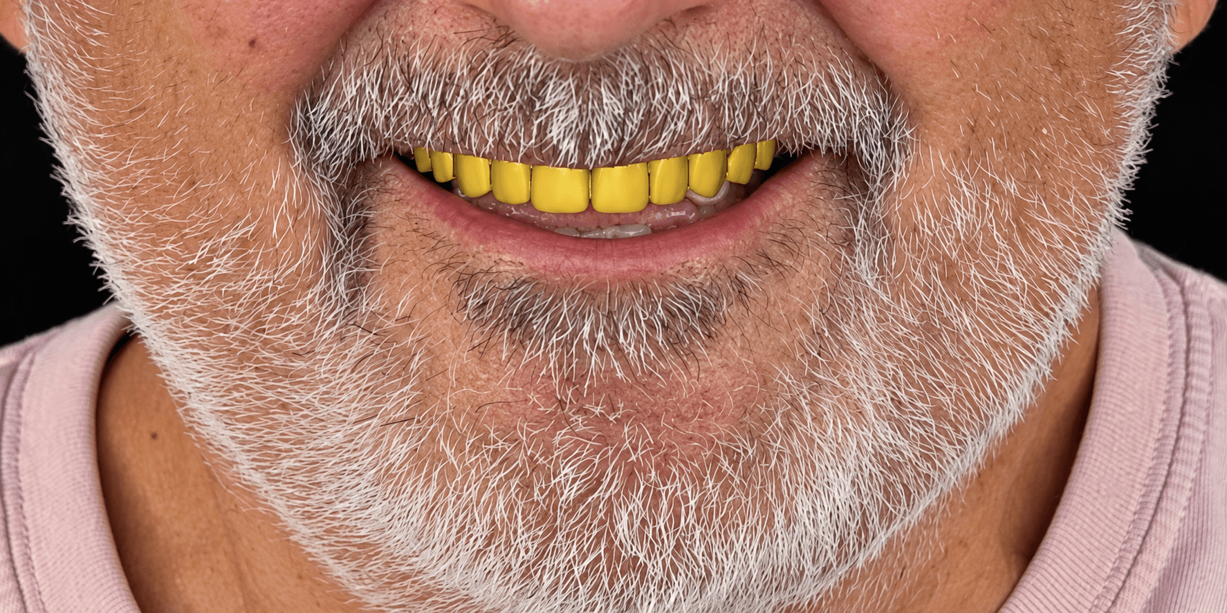 Upper Temporary Restoration 15–25 – Exocad