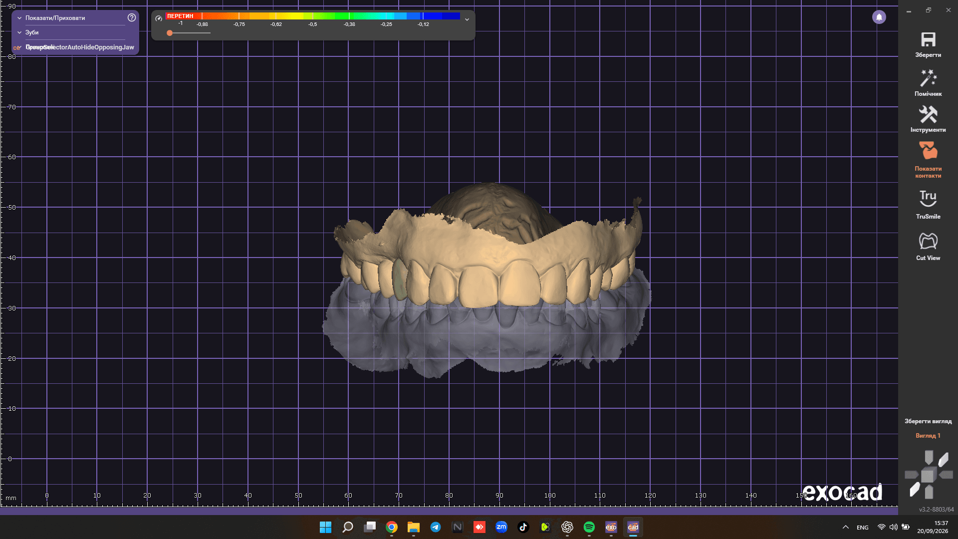 Implant Crown Design | Exocad