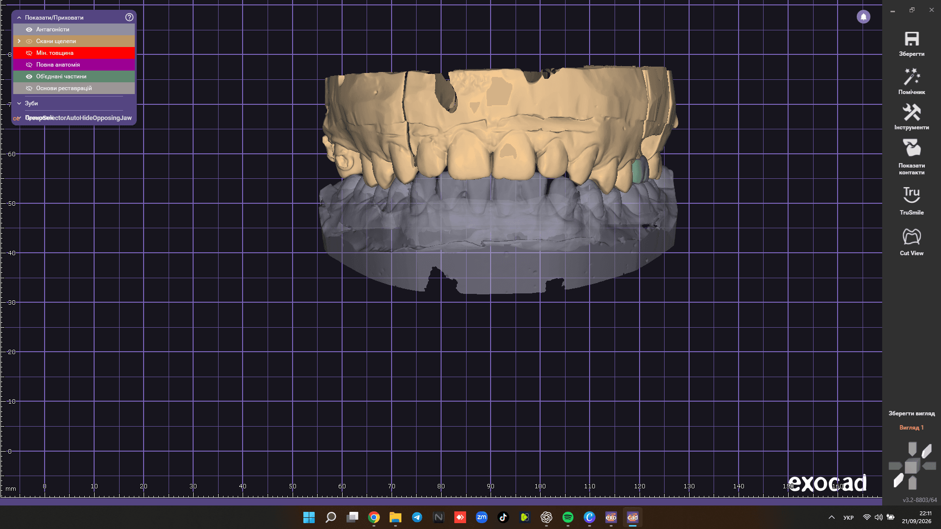 Single Crown Design | Exocad