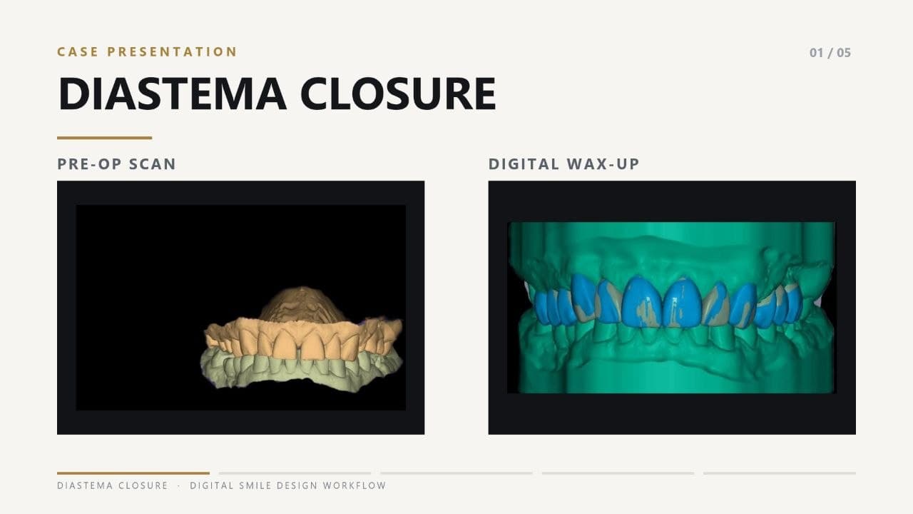 Diastema Closure