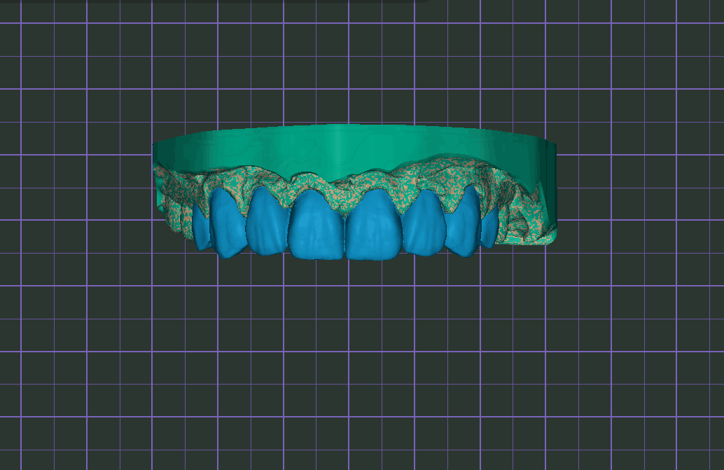 digital wax-up design