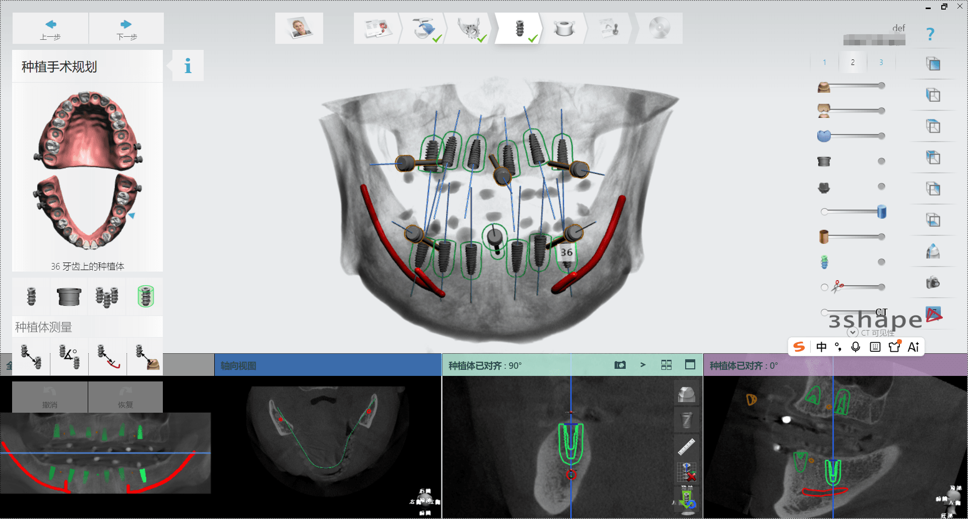 Surgical Guide CAD Design | Implant Surgical Planning